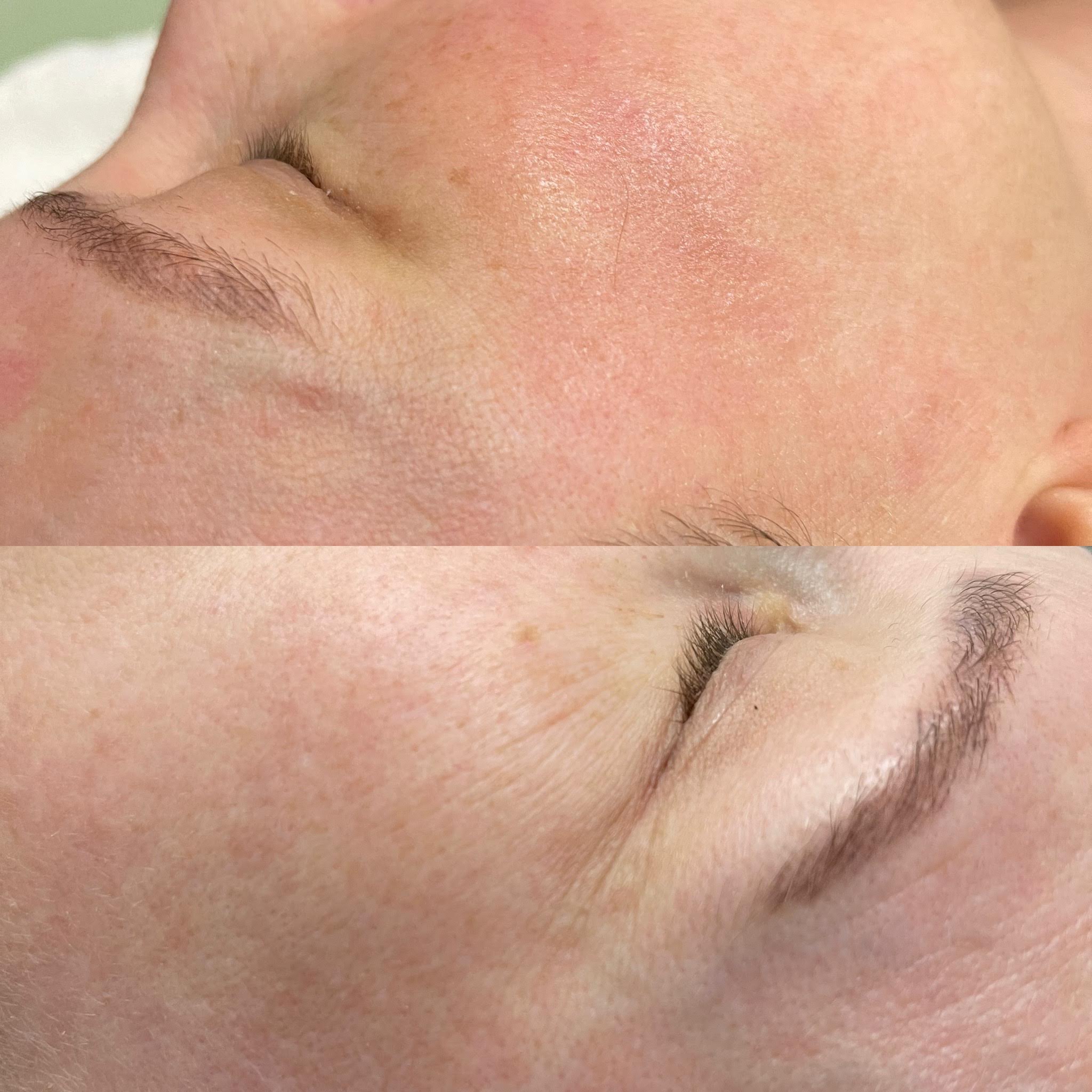 Dermaquest Chemical Peel Facial – Choice of 3 Peels - Shepherds Bush